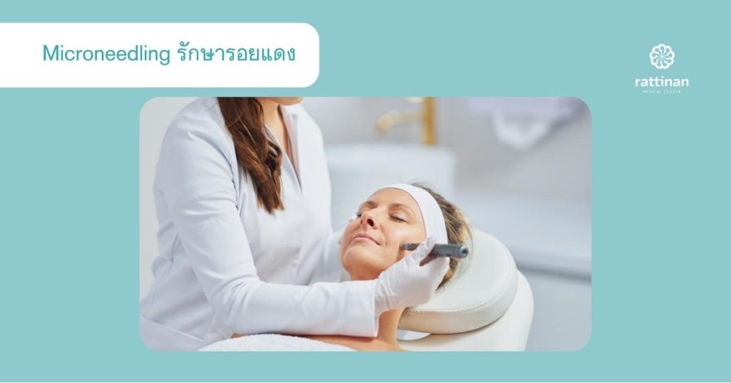 Microneedling รักษารอยแดง